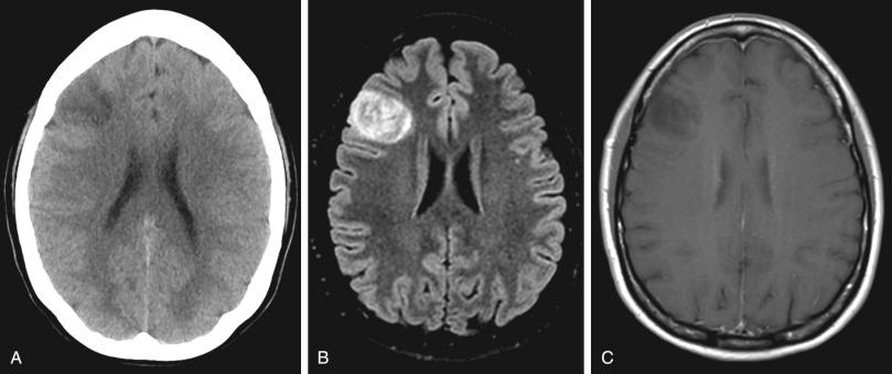 Figure 38.1, Radiologic appearance of low-grade gliomas. (A) Noncontrast CT head. Many low-grade gliomas are incidental findings on noncontrast head CT. They are typically hypodense as seen here, in the right frontal region. Oligoastrocytomas may have calcifications. (B) MRI, FLAIR sequence. Low-grade gliomas are typically hyperintense on T2/FLAIR, as seen here. (C) Gadolinium-enhanced T1 imaging. Low-grade gliomas typically do not enhance and are T1 hypointense.