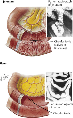Fig. 21.1, Normal small bowel containing plicae circulares (circular folds), also called valves of Kerckring . The jejunum has the highest concentration of these mucosal folds, which decrease in density in the ileum.