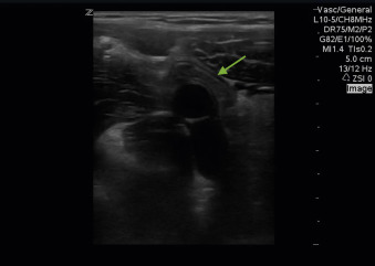 Fig. 21.11, Ultrasound image of the normal appendix demonstrating its blind end. This image shows a long-axis view of the appendix ( arrow ) located anteriorly to the iliac artery.