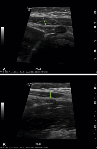 Fig. 21.12, Ultrasound images of the normal appendix in (A) long-axis and (B) in short-axis views ( arrow ).