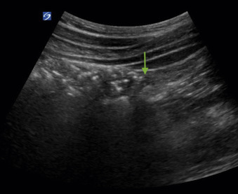 Fig. 21.13, Ultrasound image of the edge of the cecal pouch. The probe is moved from the right upper quadrant down to right lower quadrant tracing the path of the ascending colon. At the edge of the cecum there is a transition between bowel gas and abdominal contents ( arrow ).