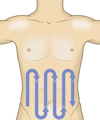 Fig. 21.3, Projected path of the probe when evaluating bowel. The bowel is examined in a systemic fashion, which is sometimes described as a “lawn mower pattern.”