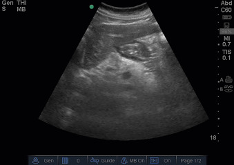 Fig. 21.4, Sonographic image of the duodenum. The duodenum is seen posterior to the gallbladder on the caudal edge of the liver.