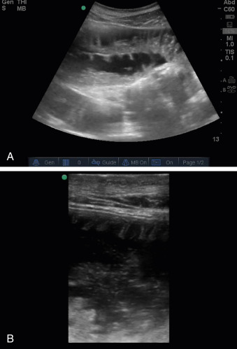 Fig. 21.5, Sonographic image of the jejunum. The jejunum contains a high density of mucosal folds known as plicae circulares (A). These are demonstrated in higher resolution with a high-frequency linear probe (B).