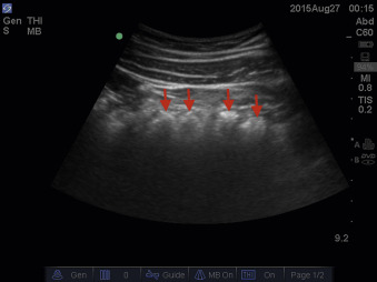 Fig. 21.6, Sonographic image of large bowel. The large bowel has periodic indentations in the wall, creating segments known as haustra ( arrows ). The air-filled transverse colon is demonstrated here.