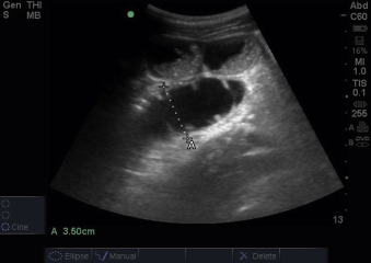 Fig. 21.7, Dilated small bowel. Long-axis sonographic image of dilated small bowel measuring 3.5 cm (35 mm) concerning for small bowel obstruction. Above this is bowel containing fluid and semisolid contents.