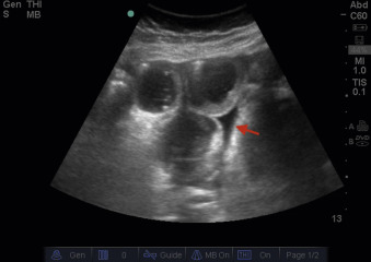 Fig. 21.9, Strangulated bowel. Multiple, dilated bowel loops with thickened walls (>3 mm) with surrounding intraperitoneal fluid suggestive of bowel strangulation. Note the triangular wedge of intraperitoneal fluid also known as a tanga sign ( arrow ).