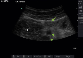 Fig. 21.10, Transverse image of the right lower quadrant of the abdomen. This transverse image using a low-frequency curvilinear probe demonstrates landmarks for identifying the appendix, including the psoas ( P ) and iliac vessels ( arrowheads ). Also seen is a portion of ileum ( arrow ).