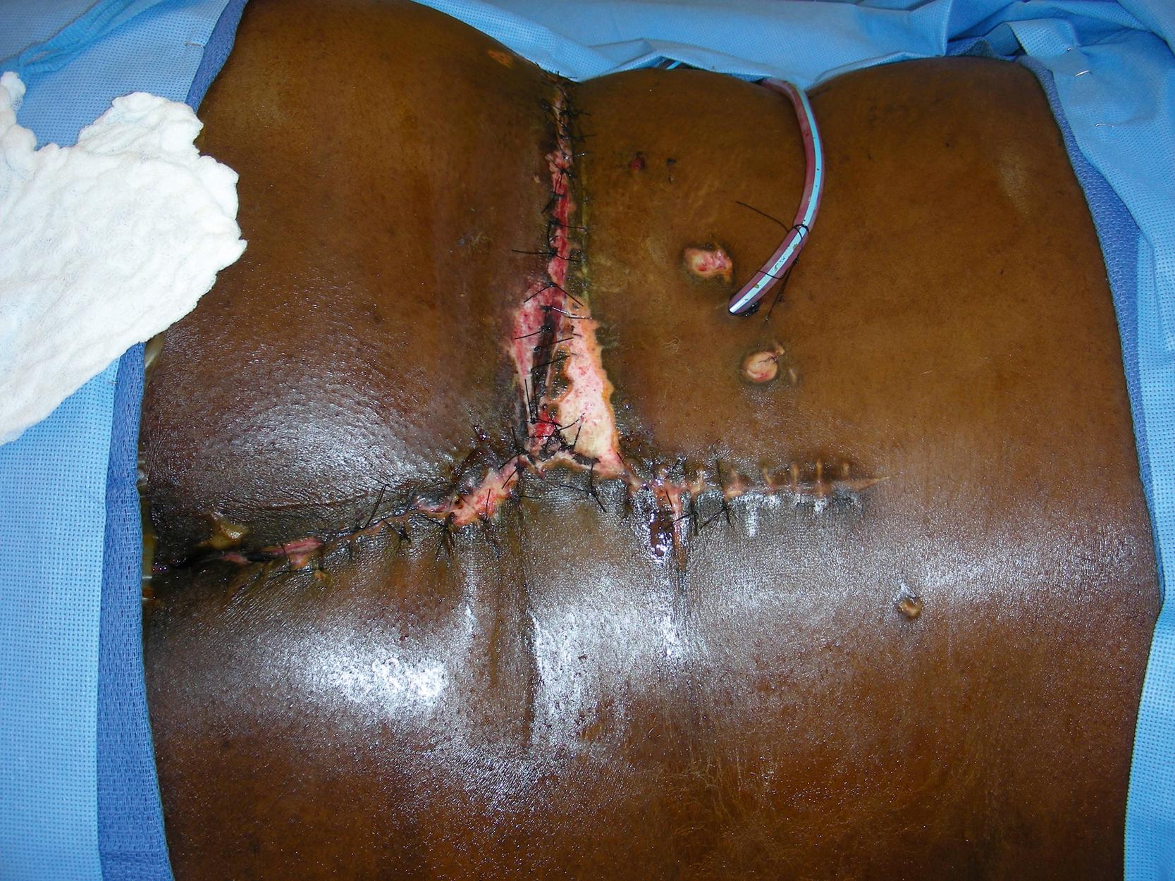 Fig. 30.1, Preoperative view showing a pending tissue necrosis of the primary incision closure sites for pelvic tumor resection and bony reconstruction.