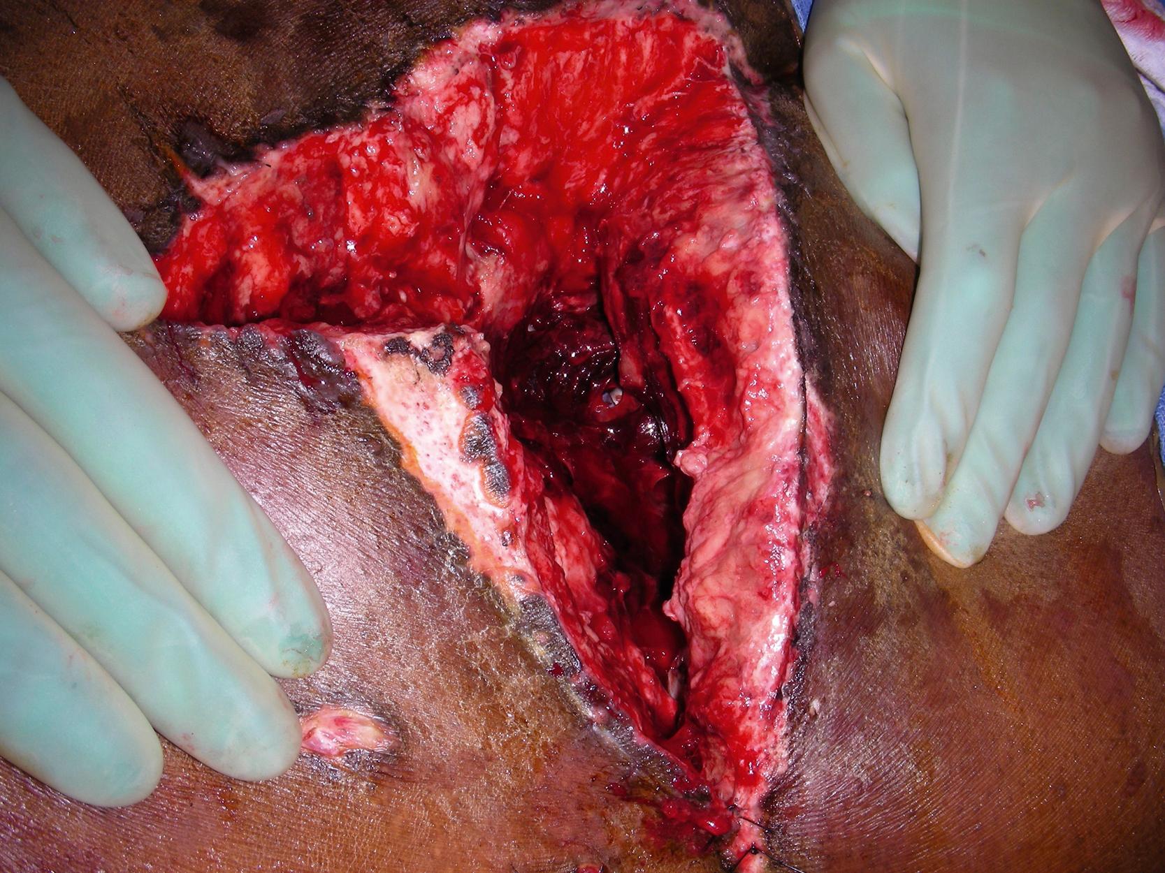Fig. 30.2, Intraoperative view showing hematoma and potentially exposed hardware if wound dehiscence would occur.