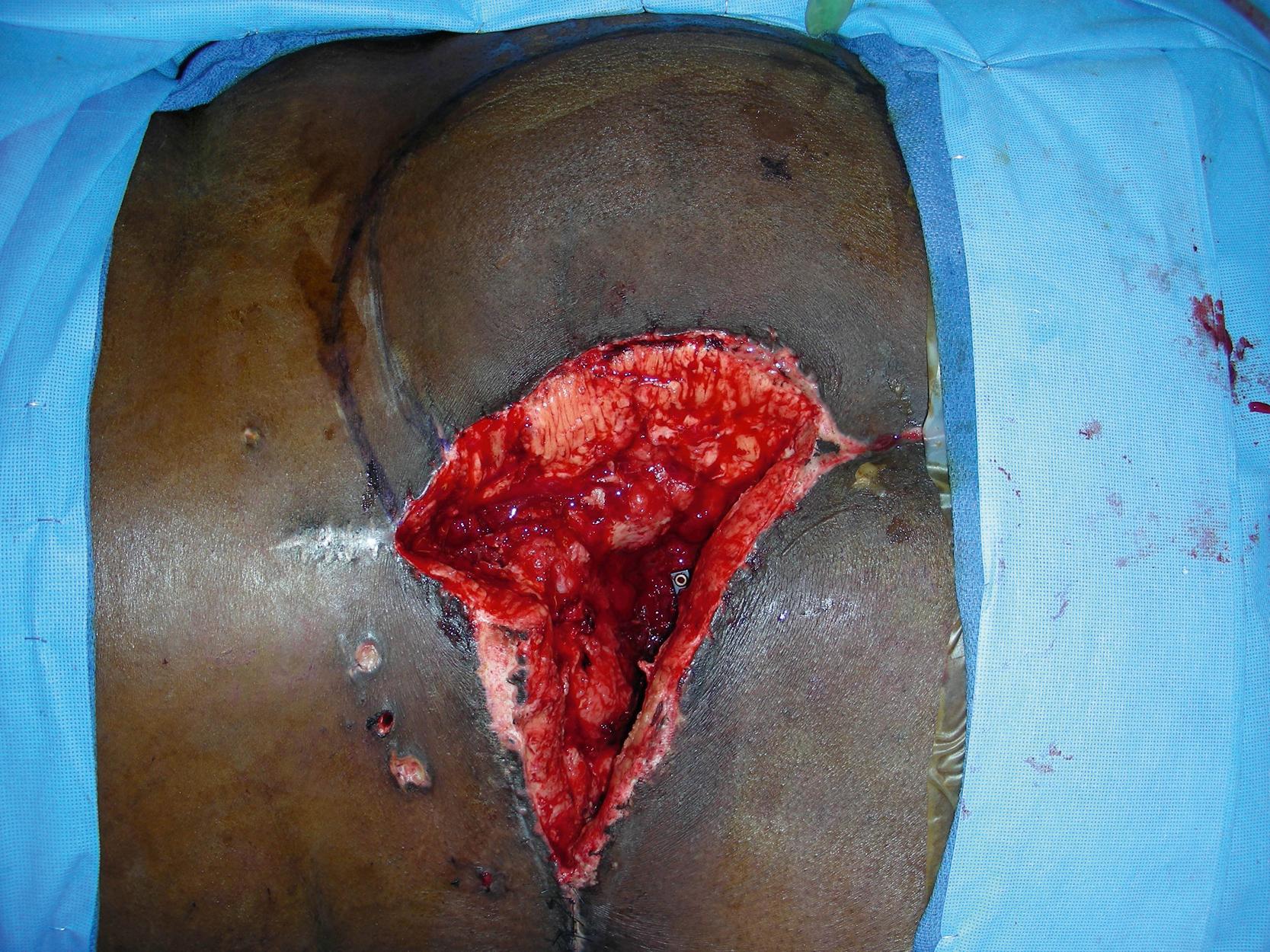 Fig. 30.3, Intraoperative view showing the design of a large perforator-plus skin rotation and advancement flap. Without proper wound closure, the hardware used for pelvic bony reconstruction would be exposed.