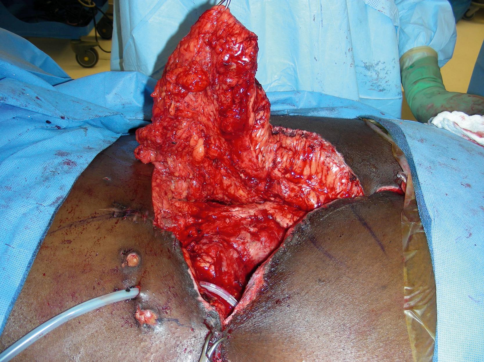 Fig. 30.4, Intraoperative view showing an elevated perforator-plus skin rotation and advancement flap.
