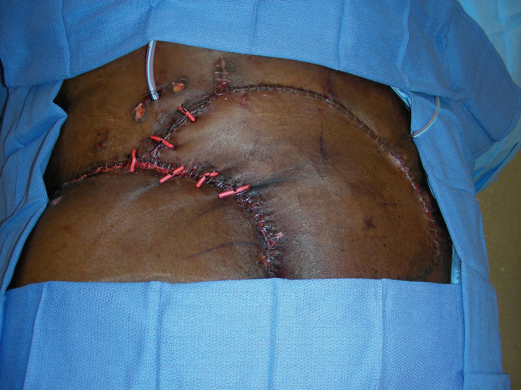 Fig. 30.6, Intraoperative view showing completion of the wound closure from the perforator-plus skin rotation and advancement flap.