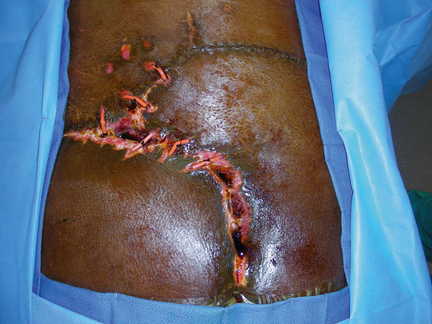 Fig. 30.7, Preoperative view showing several areas of wound dehiscence after the wound closure with perforator-plus skin rotation and advancement flap.