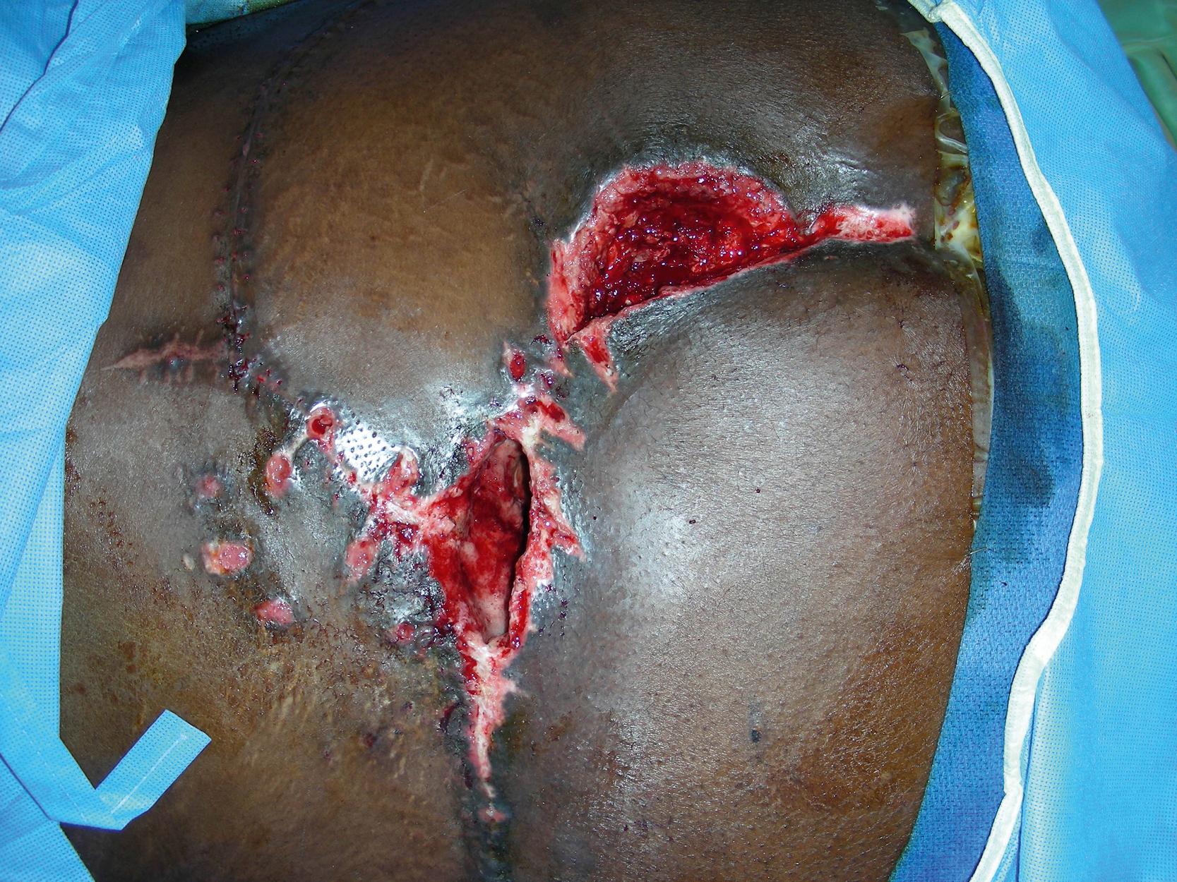 Fig. 30.8, Intraoperative view showing completion of the wound debridement after the perforator-plus skin rotation and advancement flap for wound closure.