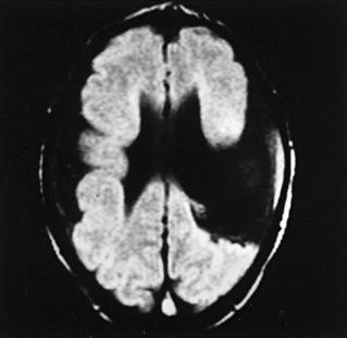 Fig. 17.1, Magnetic Resonance Imaging (MRI) of Congenital Bilateral Perisylvian Syndrome.