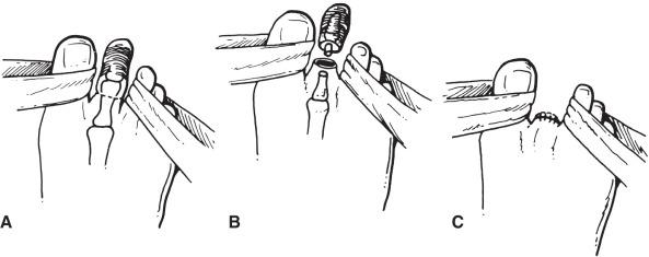 FIG 64.2, Single-toe amputation using a circular incision and transverse wound closure. (A) Circular incision for toe amputation. (B) Disarticulation of interphalangeal joint. (C) Wound closure.