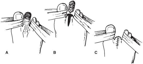 FIG 64.3, Single-digit ray amputation of the foot. The dorsal and plantar incisions are closed in their original direction; the toe incision can be closed either vertically or transversely. (A) Incision encircles the toe and extends onto the dorsum. (B) Disarticulation of the joint. (C) Wound closure.
