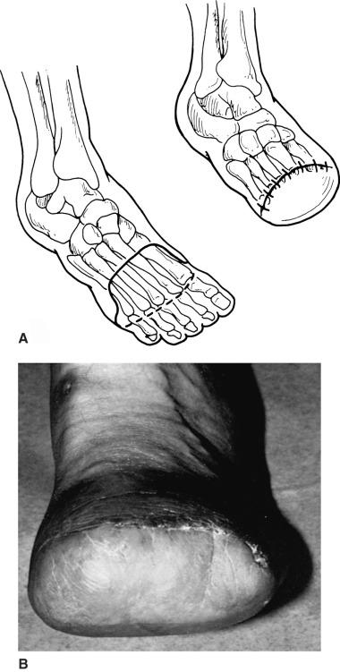 FIG 64.4, (A) Planned transmetatarsal plantar-based skin flap and appearance of the completed closure. (B) Healed right transmetatarsal amputation treated with immediate postsurgical prosthetic fitting, 1 month after amputation.