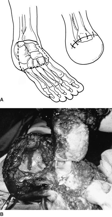 FIG 64.5, (A) Syme amputation, with a posterior heel-based skin flap, performed with the one-stage surgical technique. (B) Intraoperative photograph of a Syme amputation showing the Achilles attachment of the calcaneus (midsuperior portion of picture) , the tibial plateau, and the heel flap (lower left corner) .