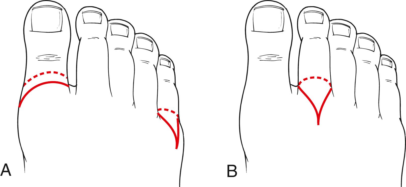 Figure 115.2, ( A ) Racket incision for first and fifth toe amputation. ( B ) Racket incision for second, third, and fourth toe amputation.