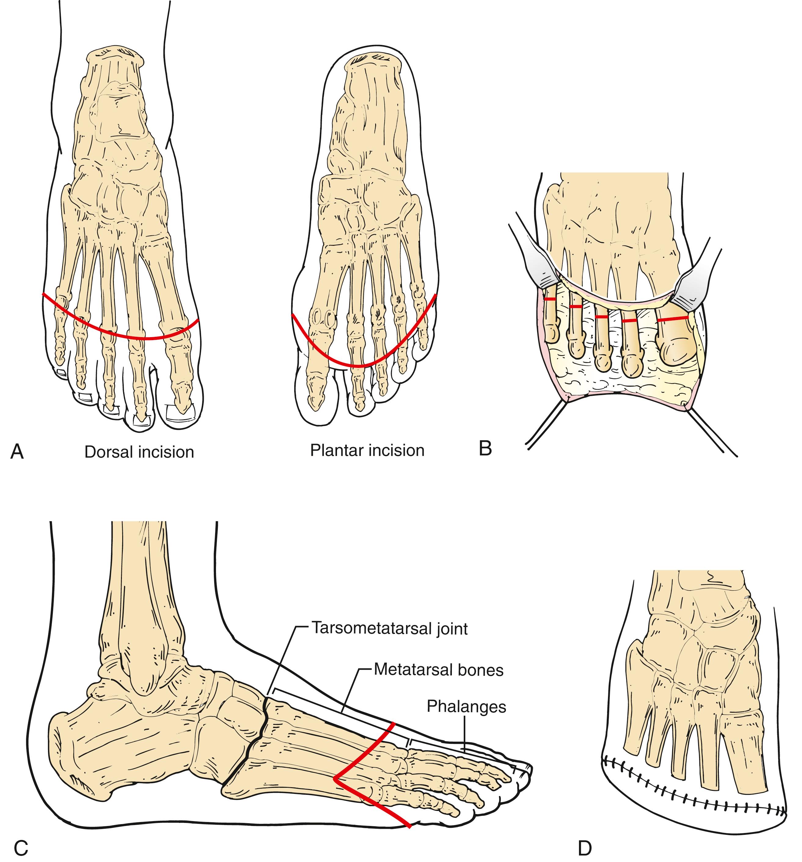 Figure 115.4, Technique of Transmetatarsal Amputation.