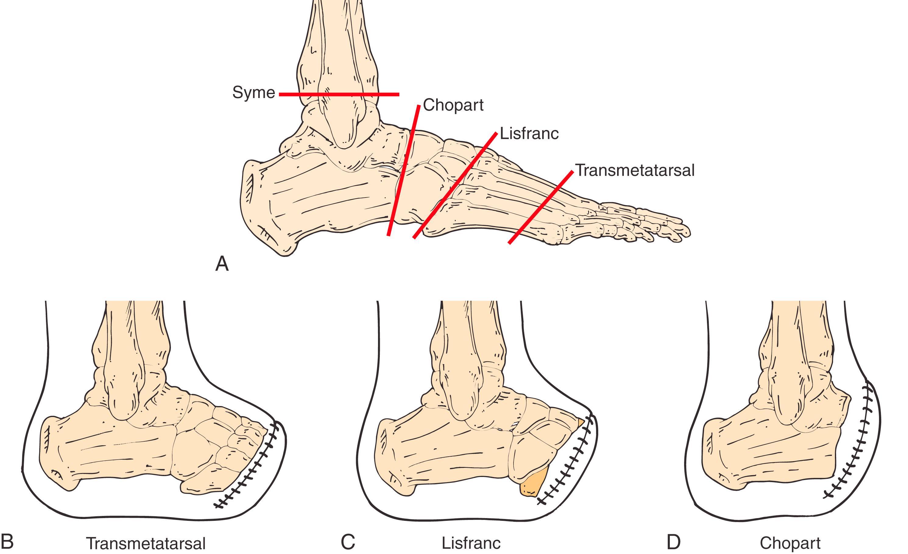 Figure 115.5, Levels of Foot Amputation. ( A ) Levels of foot amputation. ( B ) Transmetatarsal. ( C ) Lisfranc. ( D ) Chopart.