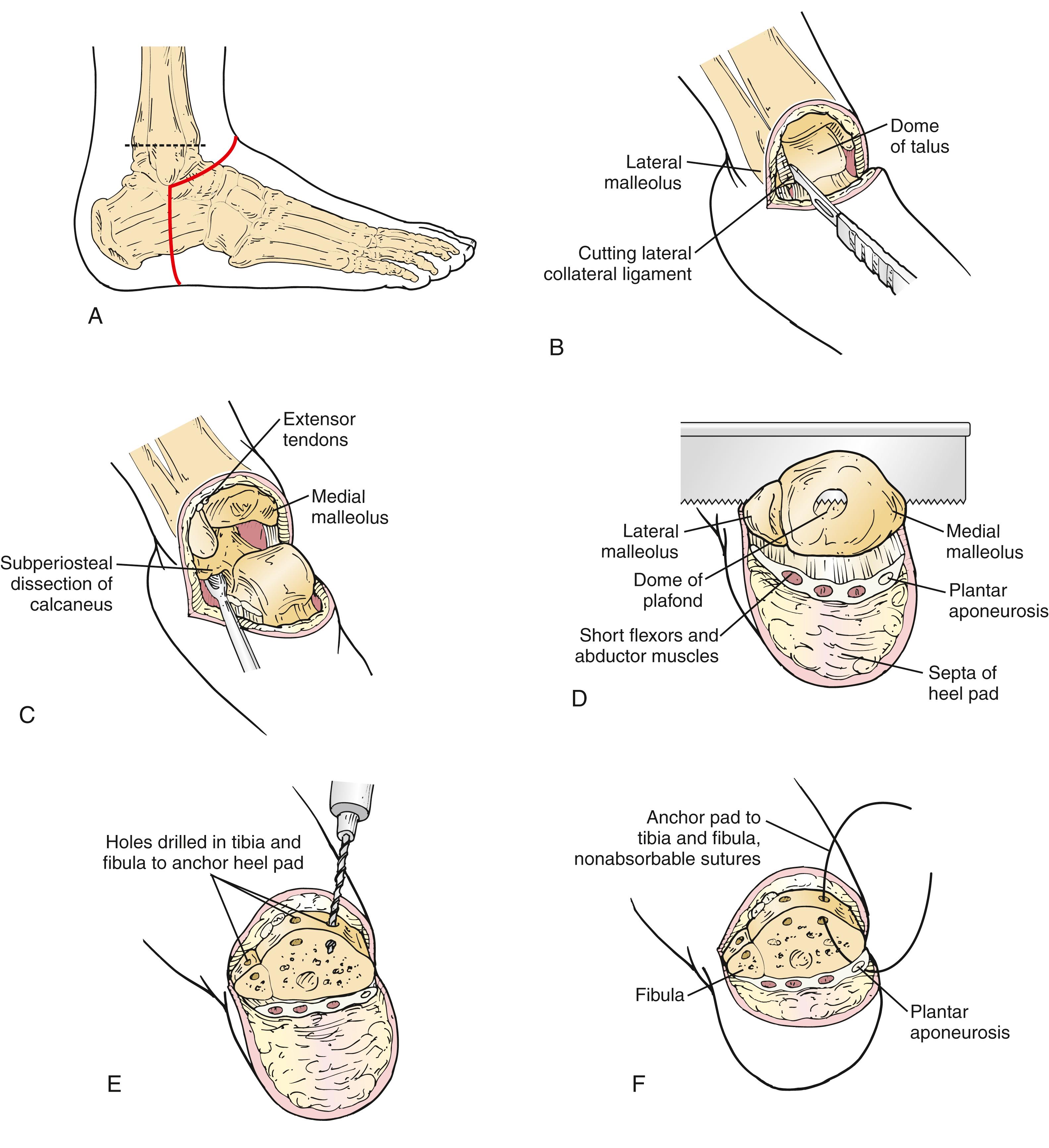 Figure 115.6, Syme Amputation.