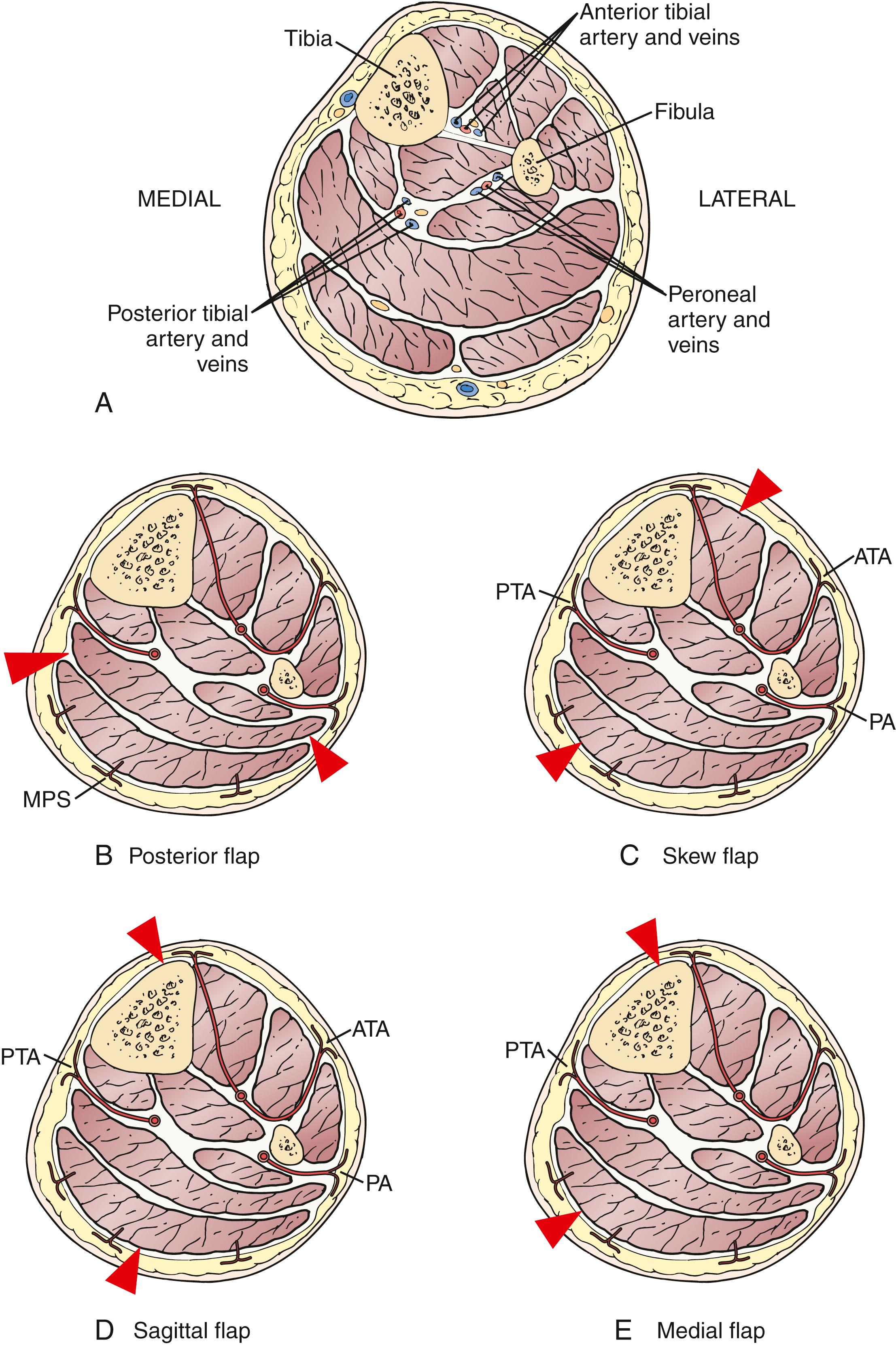 Figure 115.7, Cross-sectional Anatomy and Blood Supply to the Skin at the Level of Transtibial Amputation.