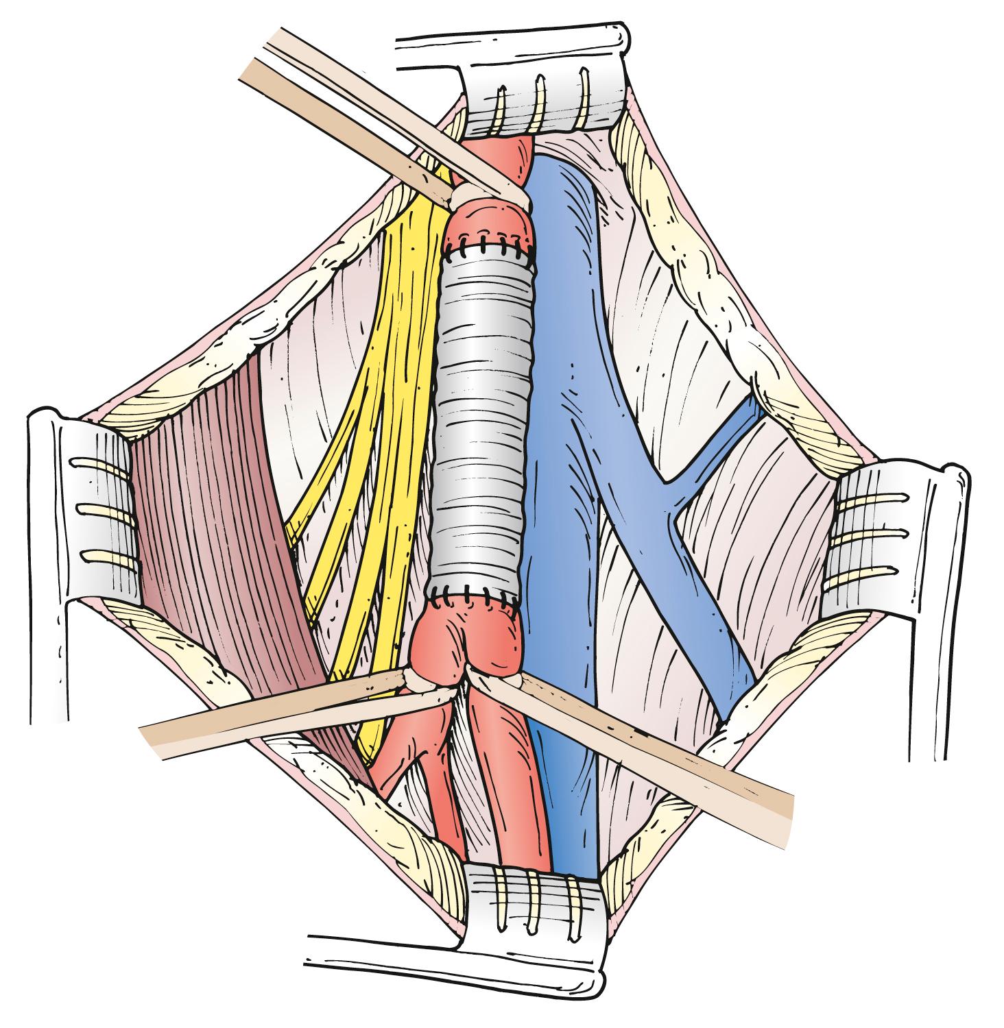 Figure 85.1, Surgical repair of an aneurysm confined to the common femoral artery can be accomplished with a simple interposition graft.