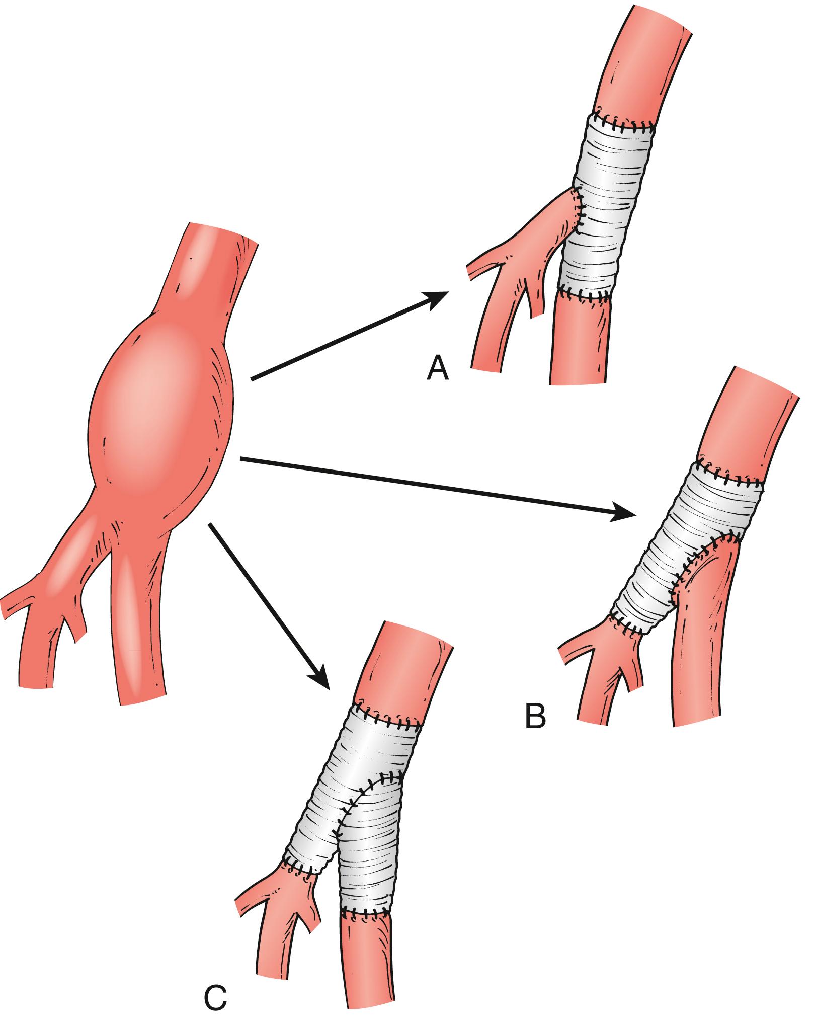 Figure 85.2, Surgical reconstruction of a femoral artery aneurysm extending beyond the common femoral artery bifurcation can be performed with different configurations, depending on local anatomy. The interposition graft can be placed between the common femoral and either the superficial femoral artery ( A ) or the profunda femoris artery ( B ) with reimplantation of the other branch into the side of the graft. ( C ) If the origin of the artery to be implanted is diseased or not long enough, a short interposition graft can be used.