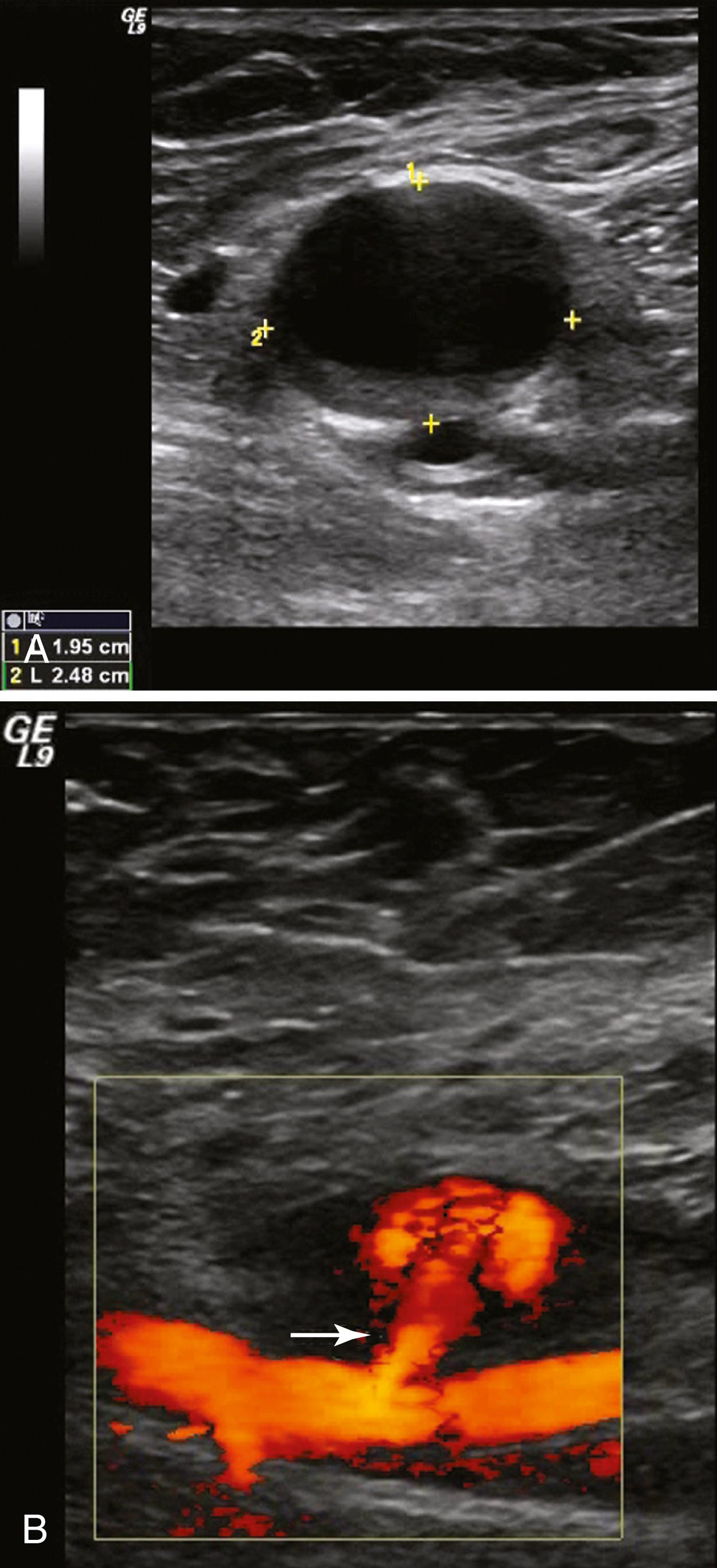 Figure 85.3, ( A ) Duplex ultrasound of a femoral false aneurysm in B mode demonstrating a large echolucent mass anterior to the femoral artery. The cursor marks the dimensions of the aneurysm cavity. ( B ) Color-flow imaging demonstrating blood entering the aneurysm sac via a relatively long channel or “neck” (arrow) , arising from the femoral artery.