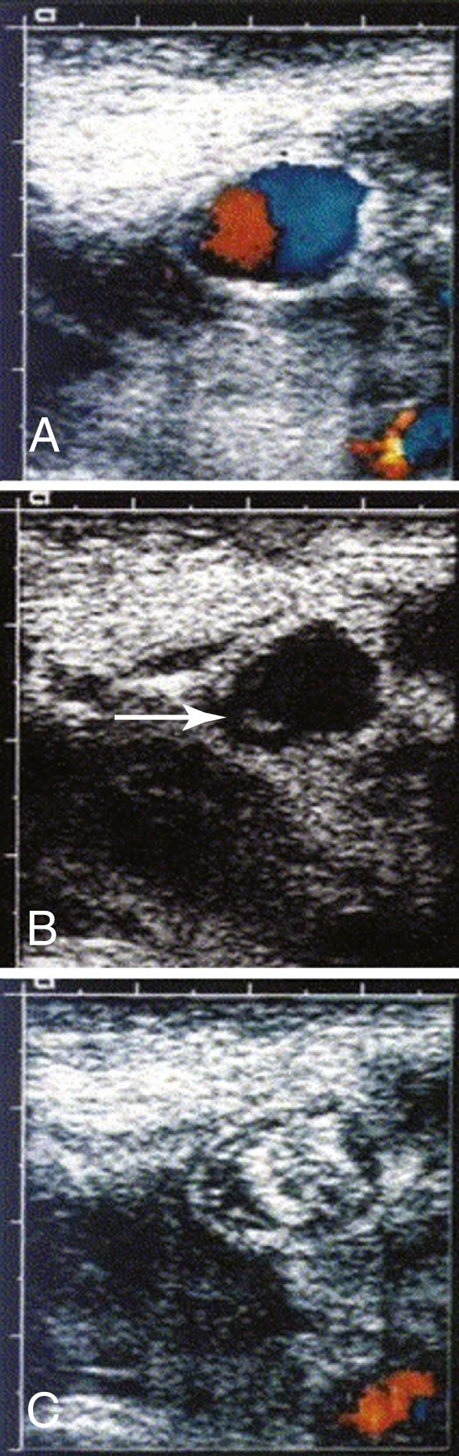 Figure 85.4, Duplex Ultrasound of a Femoral Pseudoaneurysm.