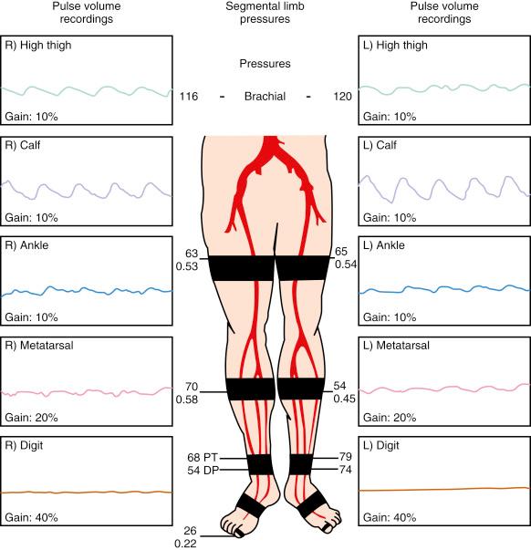 Fig. 39.2, Segmental limb pressures and pulse volume recordings (PVRs) demonstrating aortoiliac disease.