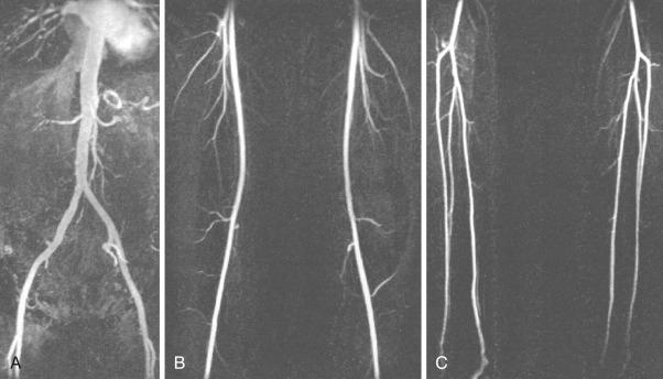 Fig. 39.3, Maximal intensity projection images of a normal lower extremity runoff three-dimensional contrast-enhanced magnetic resonance angiography.