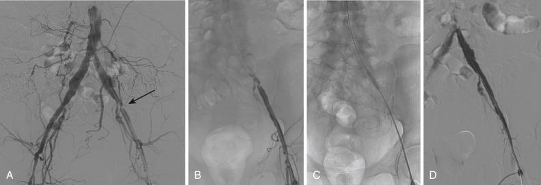 Fig. 39.4, Left external iliac artery intervention.