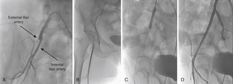 Fig. 39.5, Ostial external iliac artery occlusion.