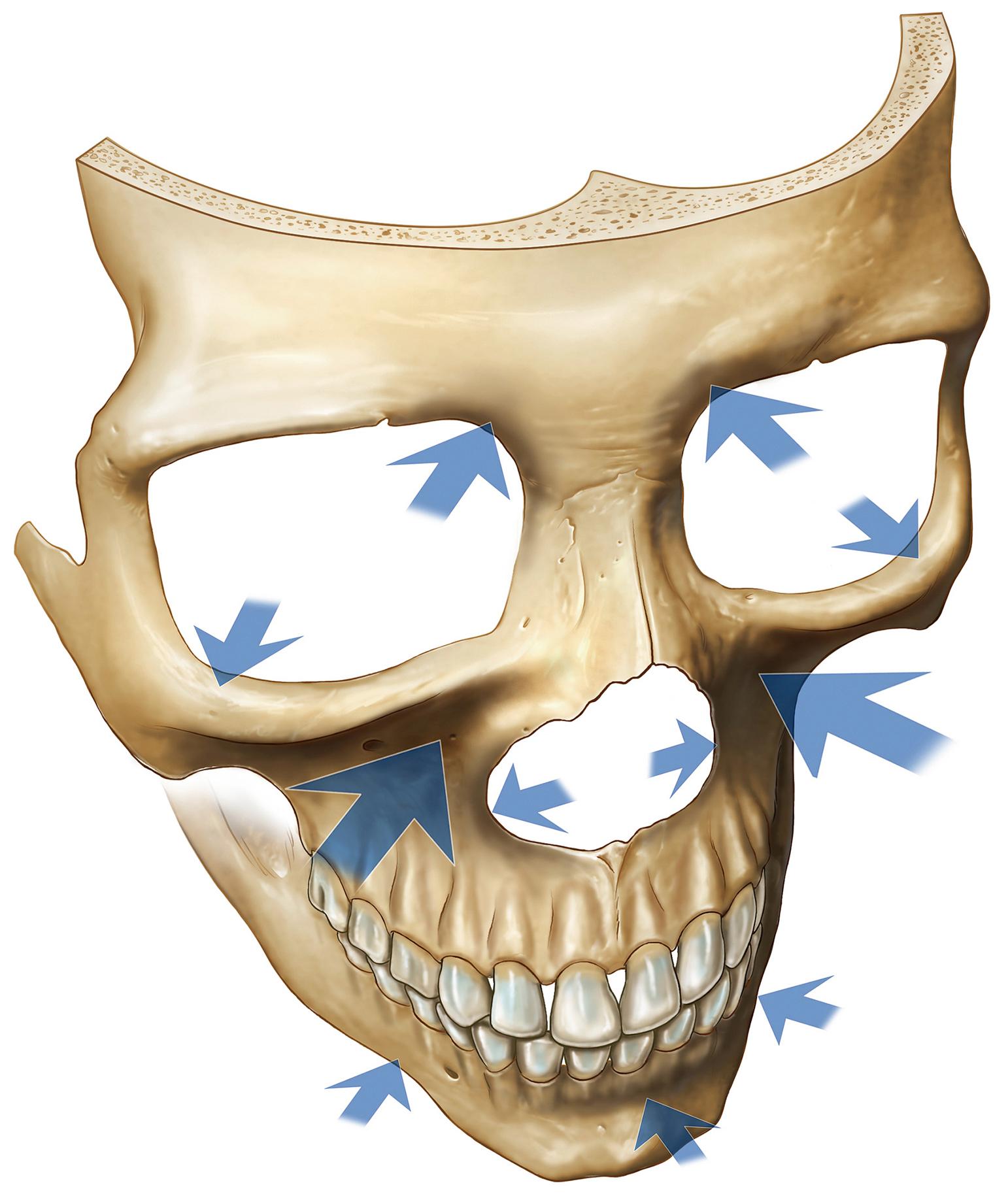 Fig. 65.1, The areas of the facial skeleton documented in the literature that selectively resorb with aging. The arrow size indicates the relative tendency for bone loss. Note the strong tendency for the medial midcheek (the maxilla) to resorb with aging, resulting in significant loss of projection of the overlying soft tissues.