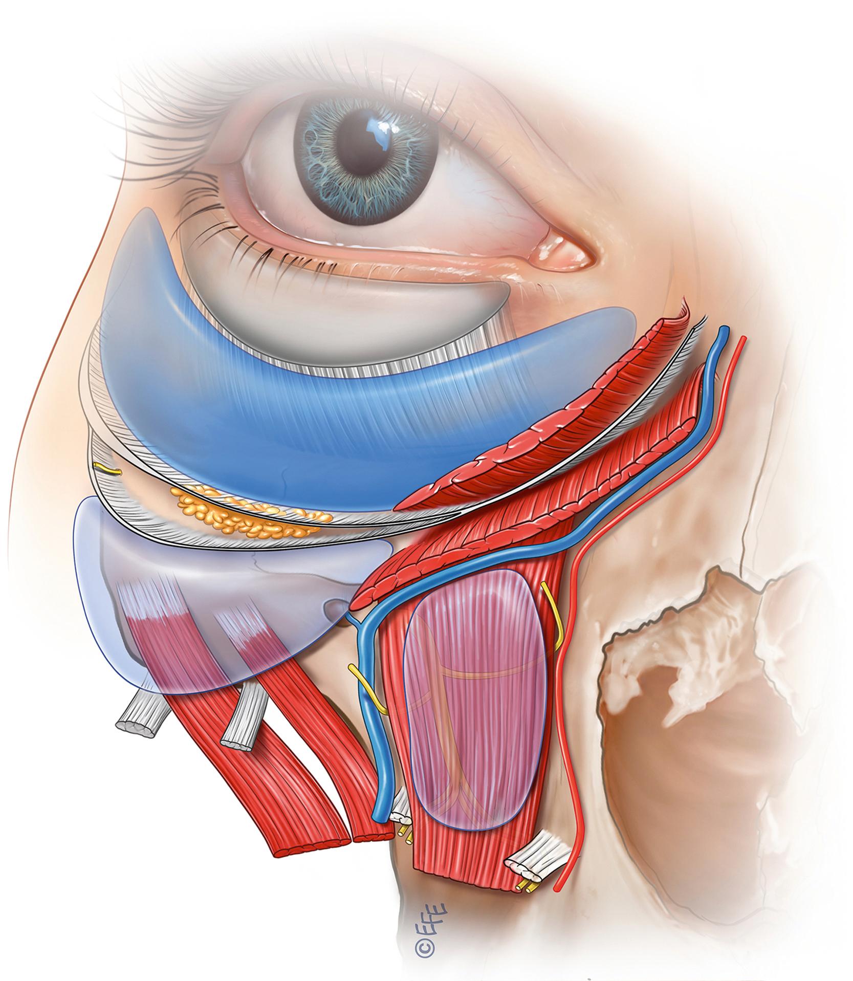 Fig. 65.3, The midcheek soft tissue spaces and facial retaining ligaments.