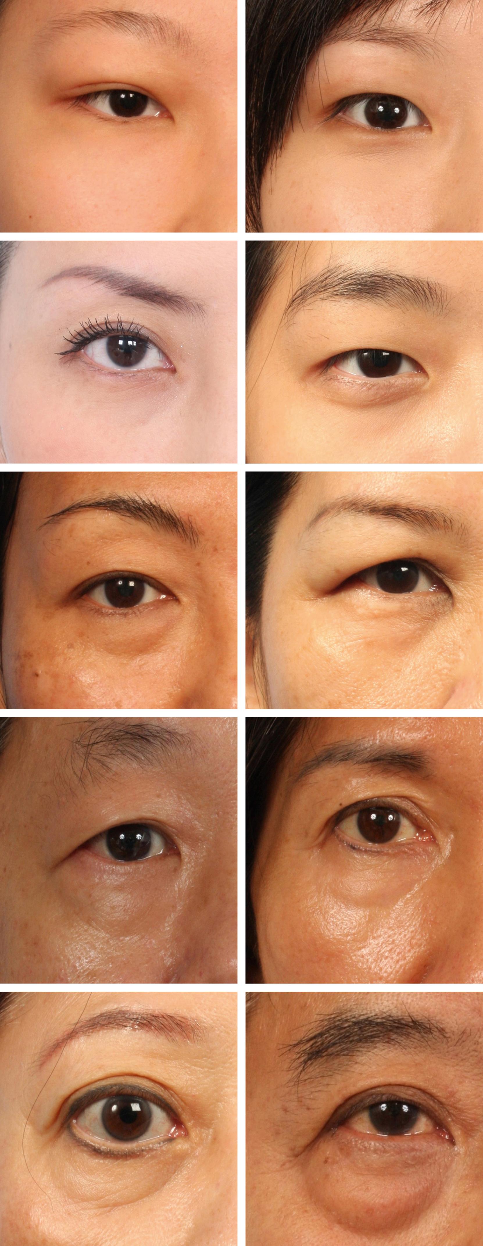 Fig. 65.4, A grading system for the tear trough (TT) deformity. Top row: Grade 0 TT: This is a youthful lower eyelid. The lid–cheek junction is high with no evident tethering seen from the tear trough ligament. A pretarsal bulge (from a hypertrophic orbicularis oculi) may (right image) or may not (left image) be present. Second row: Grade 1 TT: The tear trough is seen in repose as a shallow groove extending from just below the medial canthus to (but not extending beyond) the medial pupil line. Eye bags are absent and a pretarsal bulge may (right image) or may not (left image) be present. Third row: Grade 2 TT: The clinical findings are similar to Grade 1 TT but with the addition of the presence of eye bags. Fourth row: Grade 3 TT: The tear trough becomes continuous with the palpebromalar groove with a visually distinct (and low) lid–cheek junction (or separation). Eye bags are seen and midcheek retrusion and ptosis seen below this. Fifth row: Grade 4 TT: A sharply demarcated and continuous lid–cheek junction is seen. Prominent eye bags above and midcheek descent and retrusion is seen below the lid–cheek junction.