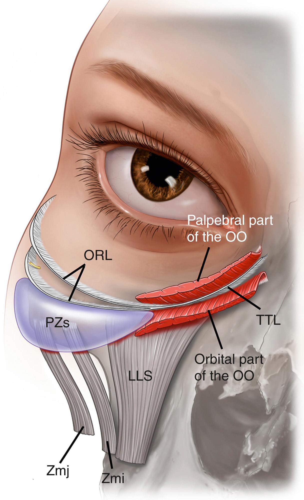 Fig. 65.5, The anatomy of the tear trough ligament.