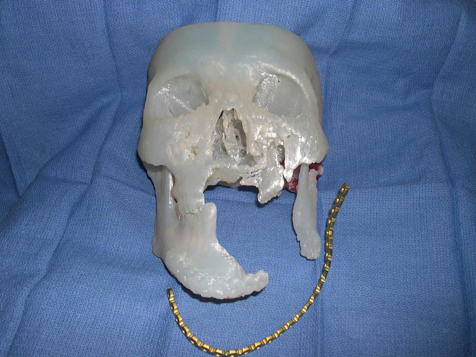 Fig. 5.3, Preoperative 3-D dental model showing an exact mandibular bony defect and a prebent reconstruction plate used for the reconstruction.