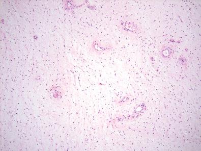 Figure 17.1, Deep Angiomyxoma.