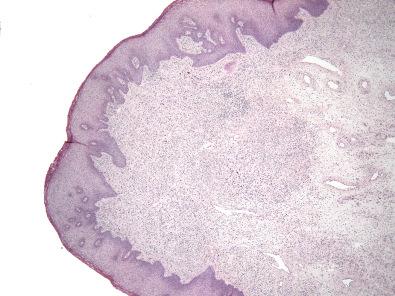 Figure 17.3, Fibroepithelial Stromal Polyp.