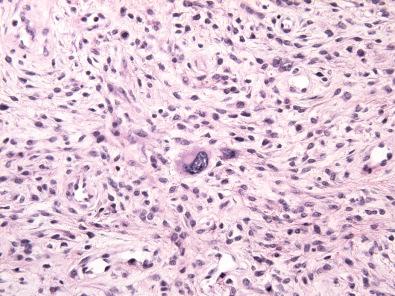 Figure 17.6, Fibroepithelial Stromal Polyp.