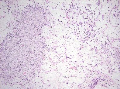 Figure 17.7, Angiomyofibroblastoma.