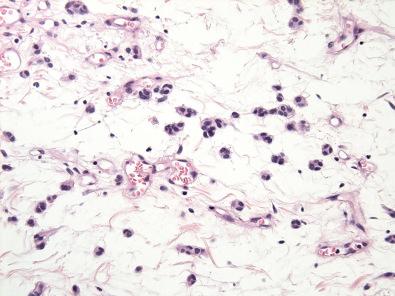 Figure 17.8, Angiomyofibroblastoma.