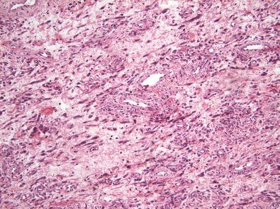 Figure 17.9, Angiomyofibroblastoma.