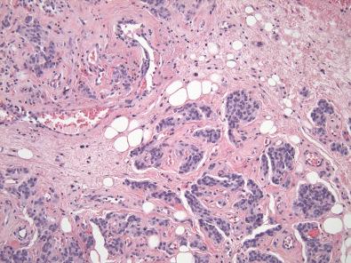 Figure 17.10, Angiomyofibroblastoma.