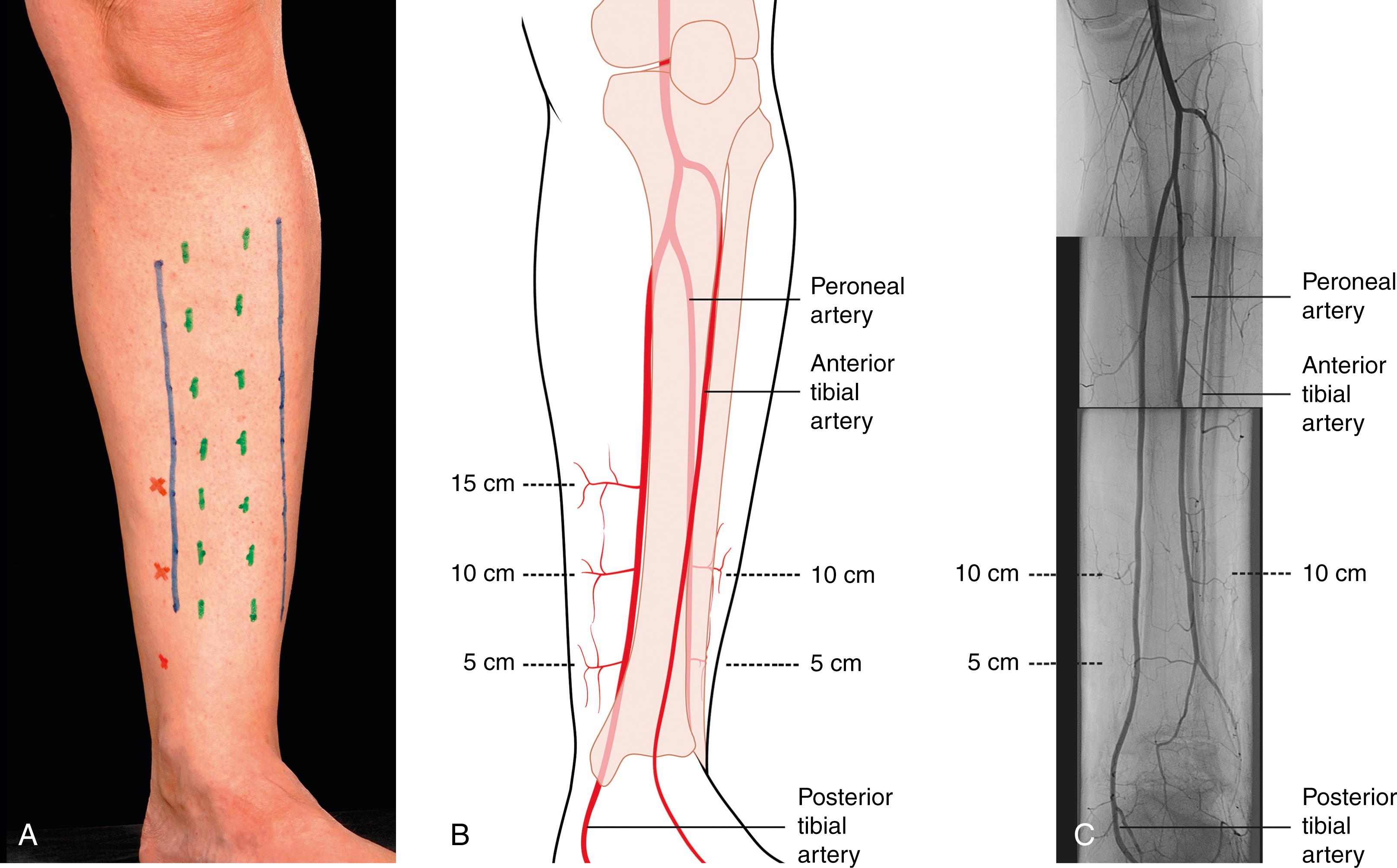 Fig. 43.1, Recommended incisions for fasciotomy and wound extensions. (A) Margins of subcutaneous border of tibia marked in green, fasciotomy incisions in blue, and the perforators on the medial side arising from posterior tibial vessels in red. (B) Line drawing depicting the location of the perforators. (C) Arteriogram demonstrating perforators. The 10 cm perforator on the medial side is typically the largest and most reliable for distally-based fasciocutaneous flaps. In this patient, the anterior tibial artery had been disrupted following an open dislocation of the ankle; hence the poor flow evident in this vessel in the distal one-third of the leg. The distances of the perforators from the tip of the malleolus are approximate and can vary between patients.